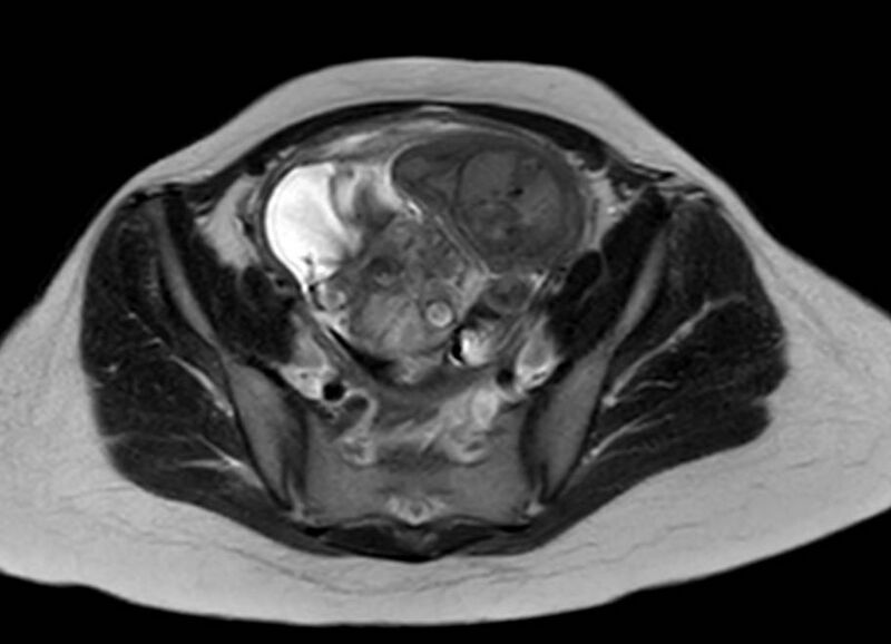 File:Appendicitis in gravida (MRI) (Radiopaedia 89433-106395 Axial T2 55).jpg