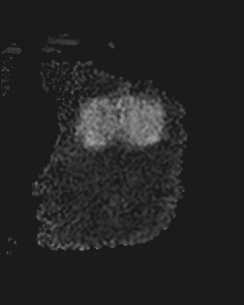 Appendicitis in gravida (MRI) (Radiopaedia 89433-106395 Coronal ADC 55).jpg