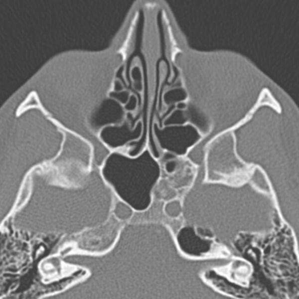 File:Arrested pneumatization of the sphenoid (Radiopaedia 10700-11172 Axial non-contrast 3).jpg
