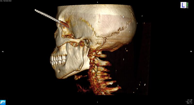File:Arrow injury to the head (Radiopaedia 75266-86388 3D horizontal 26).jpg