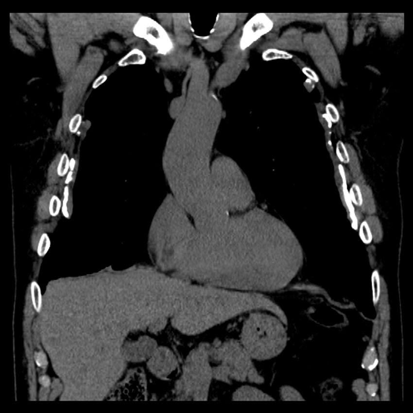 Asbestos-related pleural plaques (Radiopaedia 39069-41255 Coronal non-contrast 60).jpg