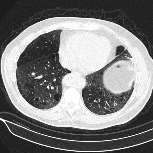 File:Aspergilloma (Radiopaedia 24521-24804 Axial lung window 19).jpg