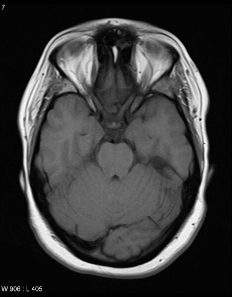 File:Astroblastoma (Radiopaedia 39792-42217 Axial T1 6).jpg