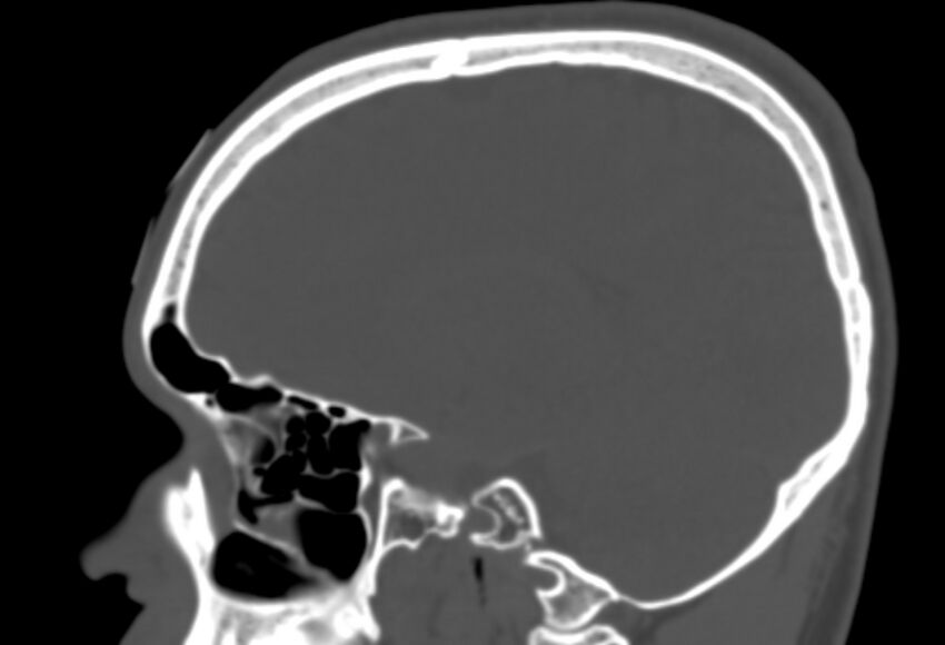 Asymptomatic occipital spur (Radiopaedia 87753-104201 Sagittal bone window 115).jpg