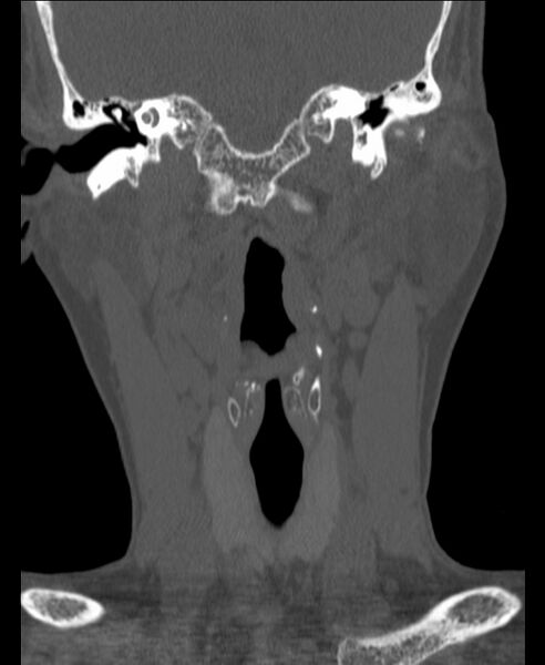 File:Atlanto-occipital assimilation with basilar invagination (Radiopaedia 70122-80188 Coronal bone window 36).jpg