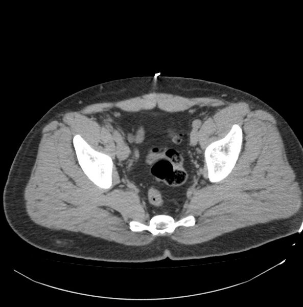 File:Atrophic kidney due to severe chronic obstructive hydronephrosis (Radiopaedia 40828-43474 Axial non-contrast 41).jpg