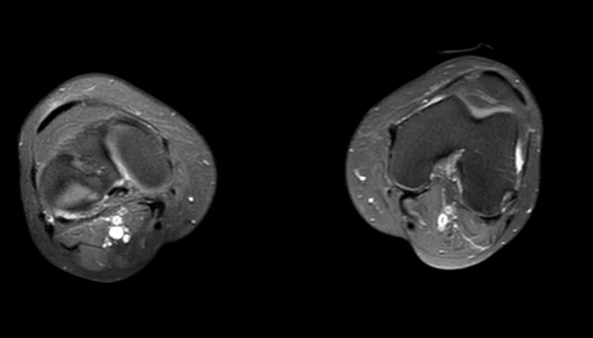 Atypical lipomatous tumor - thigh (Radiopaedia 68975-78734 Axial PD fat sat 7).jpg