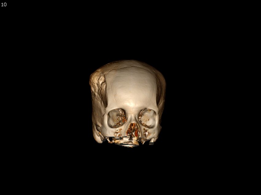 Atypical meningioma - intraosseous (Radiopaedia 64915-73867 3D volume render 10).jpg