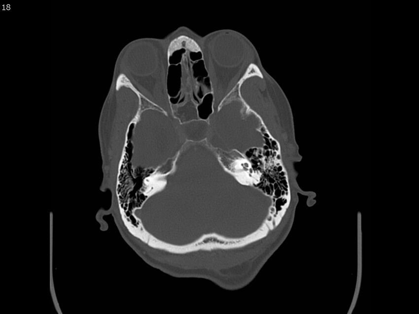 Atypical meningioma - intraosseous (Radiopaedia 64915-73867 Axial C+ bone window 18).jpg