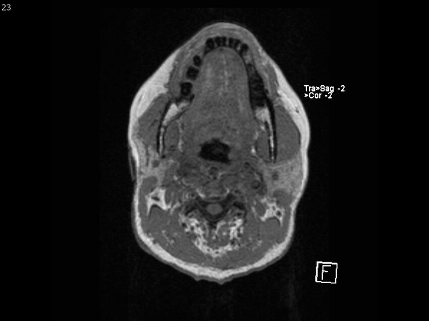 Atypical meningioma - intraosseous (Radiopaedia 64915-74572 Axial T1 23).jpg