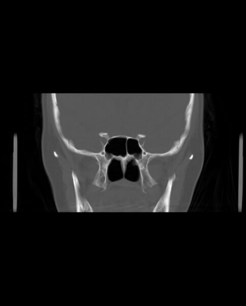 File:Automastoidectomy with labyrinthine fistula (Radiopaedia 84143-99411 Coronal non-contrast 58).jpg