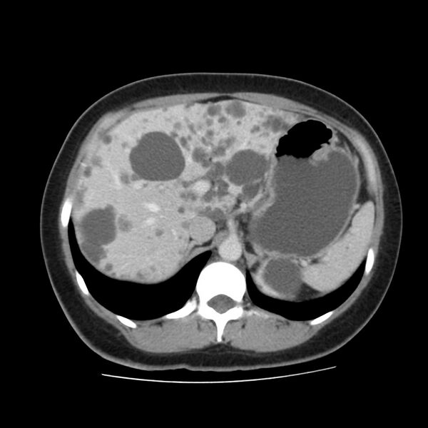 File:Autosomal dominant polycystic kidney disease (Radiopaedia 23061-23093 C 16).jpg