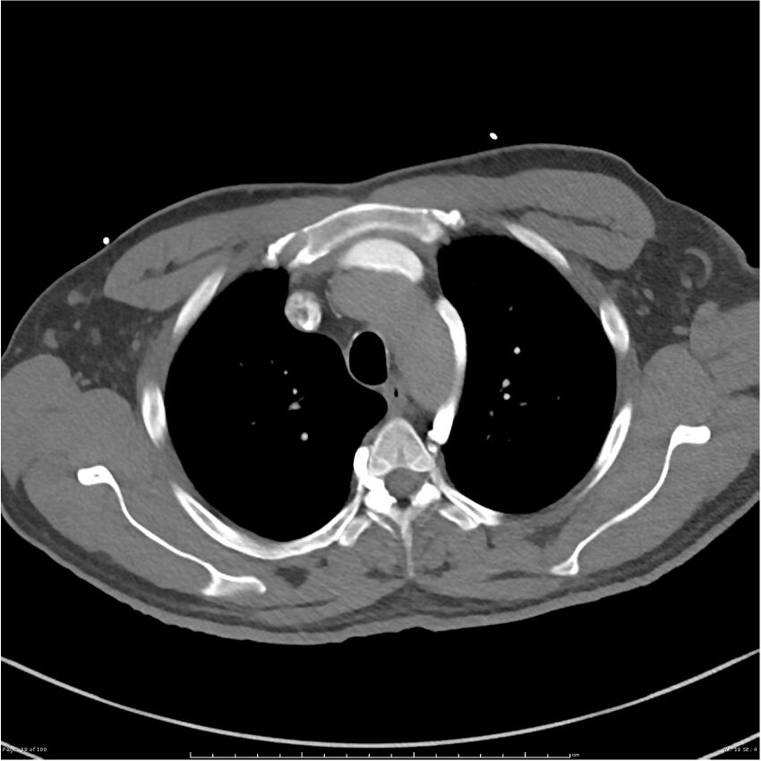 Azygos venous system anatomy (CT pulmonary angiography) (Radiopaedia 25928-26077 Axial C+ CTPA 19).jpg