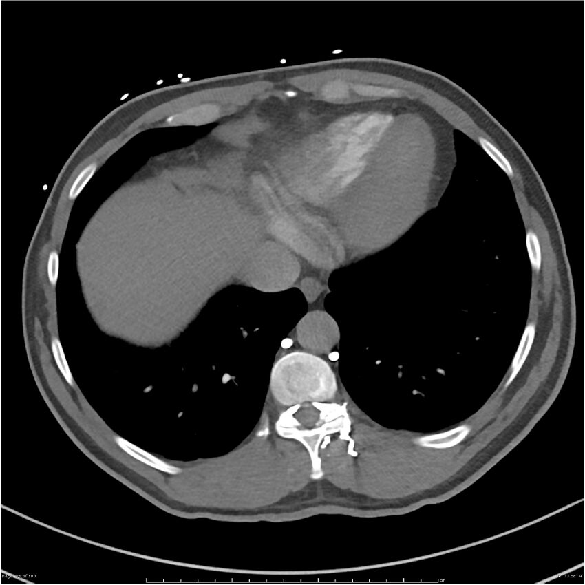 Azygos venous system anatomy (CT pulmonary angiography) (Radiopaedia 25928-26077 Axial C+ CTPA 71).jpg