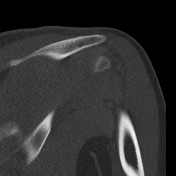 File:Bankart lesion (Radiopaedia 22771-22798 Coronal bone window 33).jpg