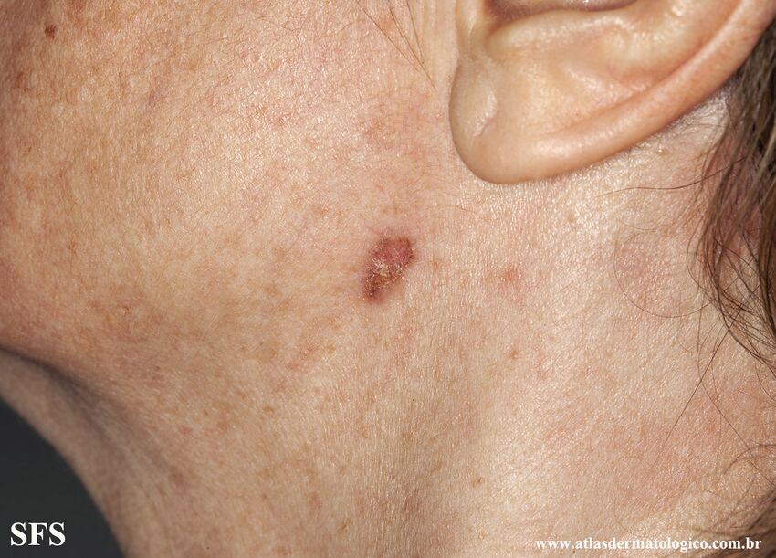 Basal Cell Carcinoma (Dermatology Atlas 283).jpg