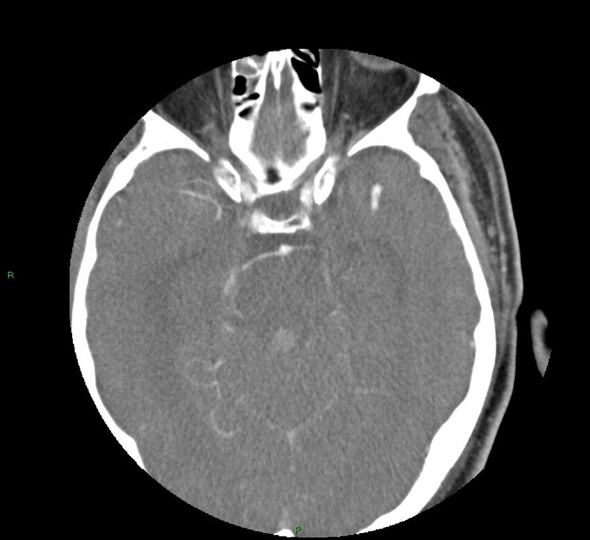 Basal ganglia hemorrhage (Radiopaedia 58763-65985 D 72).jpg