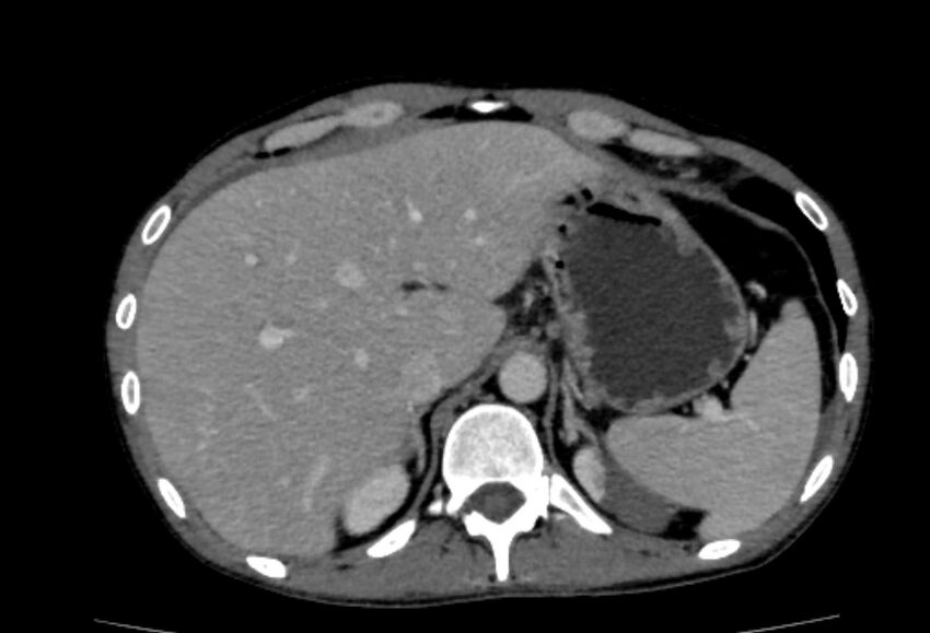 Behçet's disease- abdominal vasculitis (Radiopaedia 55955-62570 A 12).jpg