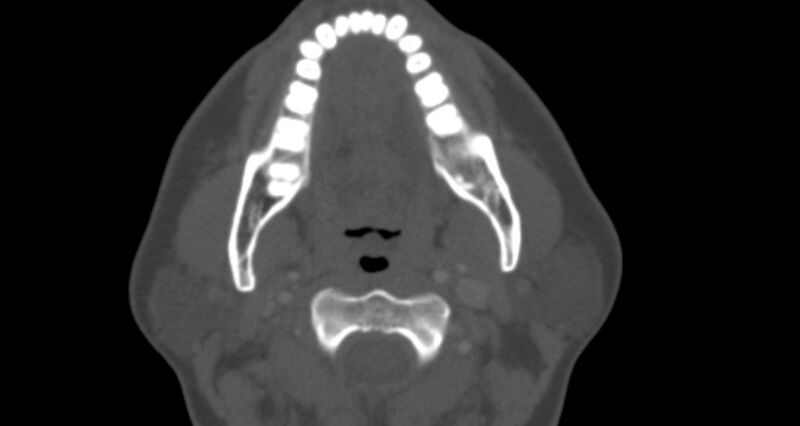 File:Benign mixed salivary tumor of the parotid gland (Radiopaedia 35261-36792 Axial bone window 20).jpg