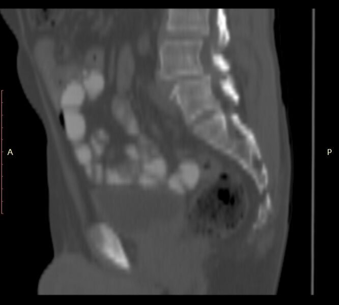 File:Bertolotti syndrome (Radiopaedia 58974-66235 Sagittal bone window 30).jpg