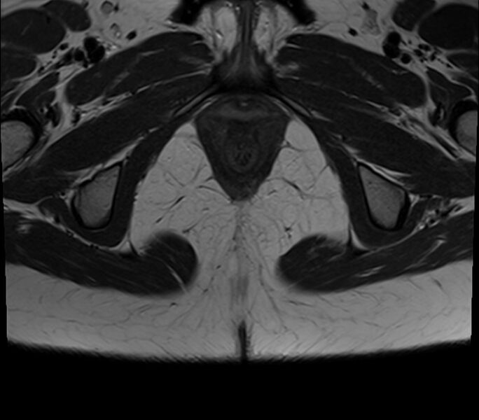 File:Bicornuate uterus (Radiopaedia 71214-81511 Axial T2 2).jpg