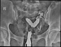 Bicornuate vs septate uterus (Radiopaedia 62784-71120 C 1).jpg