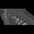 Bilateral C6-7 locked facet dislocation (Radiopaedia 28506-28748 Sagittal bone window 19).jpeg