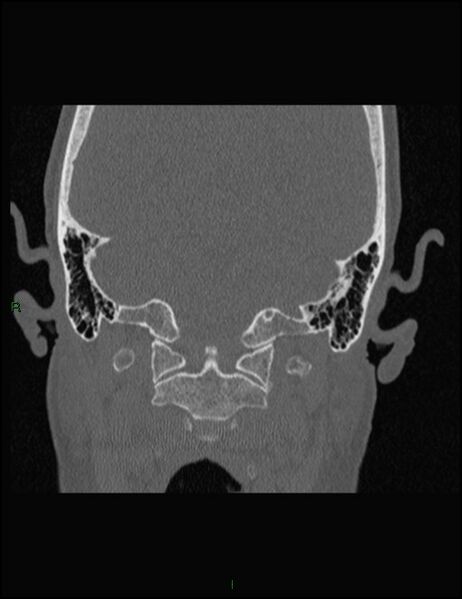 File:Bilateral frontal mucoceles (Radiopaedia 82352-96454 Coronal 351).jpg