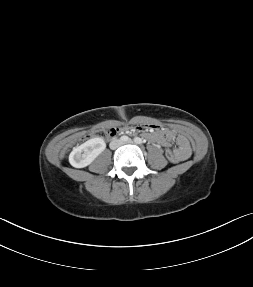 Bilateral kidney malrotation (Radiopaedia 72227-82749 A 40).jpg