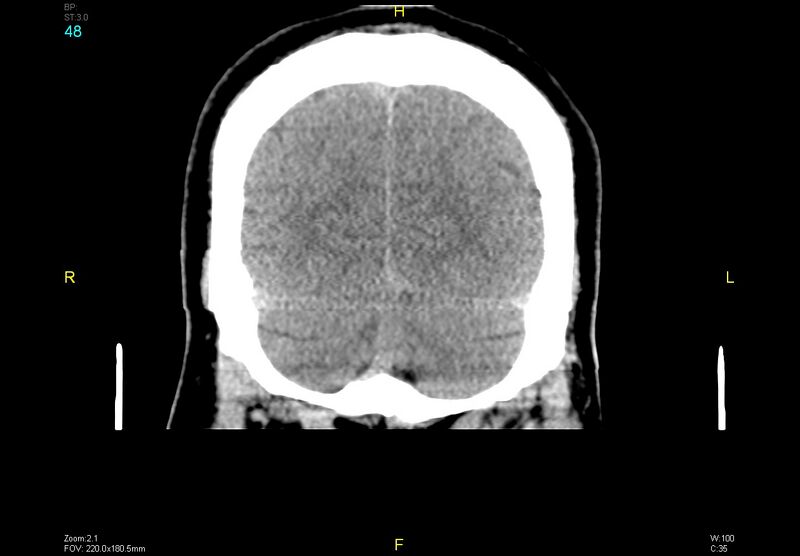 File:Bilateral medial medullary infarction (Radiopaedia 42220-45295 Coronal non-contrast 48).jpg