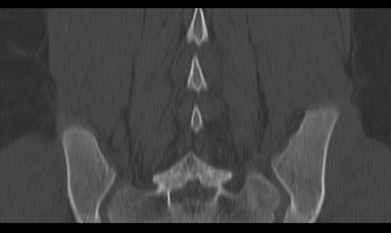 File:Bilateral pars defect (Radiopaedia 26691-26846 Coronal bone window 37).jpg