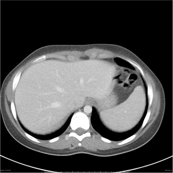 File:Bilateral ureteritis and cystitis (Radiopaedia 25340-25594 A 8).jpg