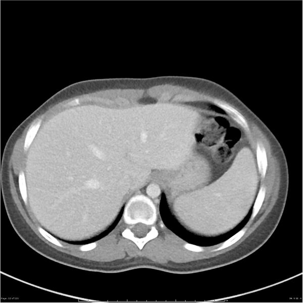 File:Bilateral ureteritis and cystitis (Radiopaedia 25340-25594 A 9).jpg
