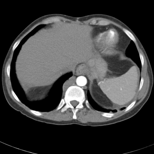 File:Biliary necrosis - liver transplant (Radiopaedia 21876-21845 A 8).jpg