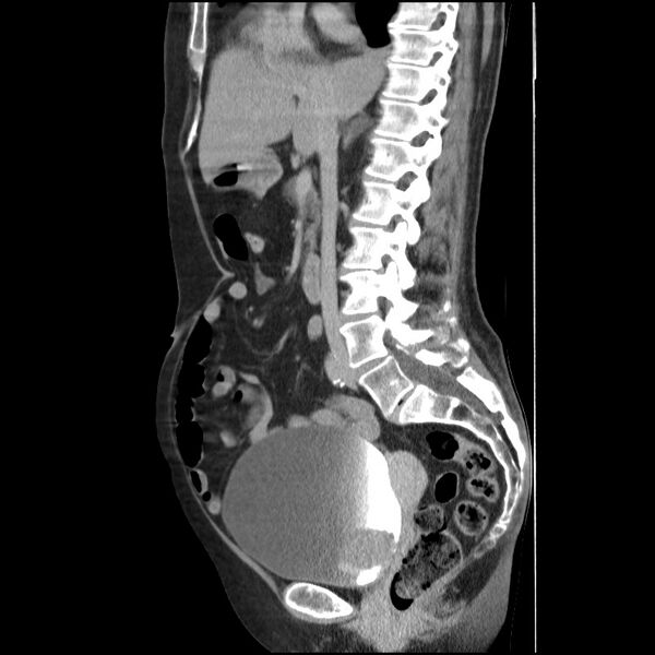 File:Bladder tumor detected on trauma CT (Radiopaedia 51809-57609 E 40).jpg