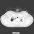 Bochdalek diaphragmatic hernia (Radiopaedia 38866-41059 Axial lung window 3).jpg