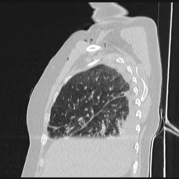 File:Boerhaave syndrome (Radiopaedia 45644-49799 Sagittal lung window 18).jpg