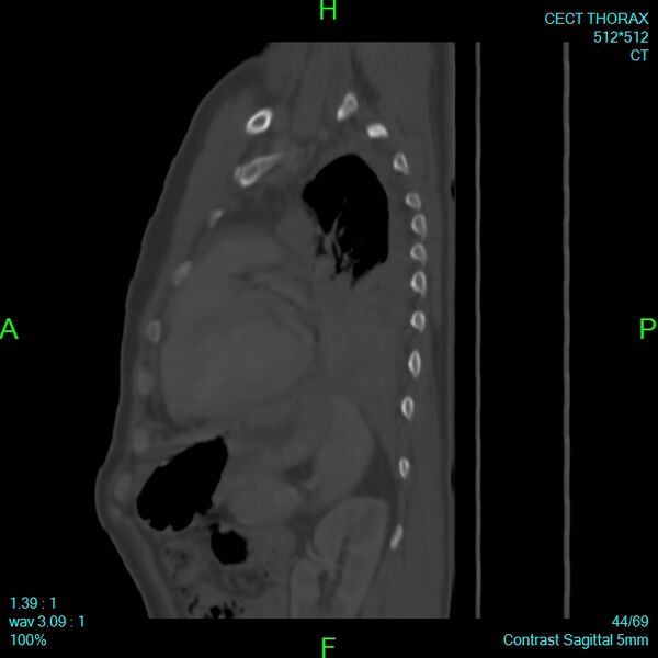 File:Bone metastases from lung carcinoma (Radiopaedia 54703-60937 Sagittal bone window 44).jpg