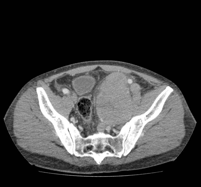 File:Bowel lymphoma complicated by bleeding after therapy (Radiopaedia 55601-62107 A 67).jpg