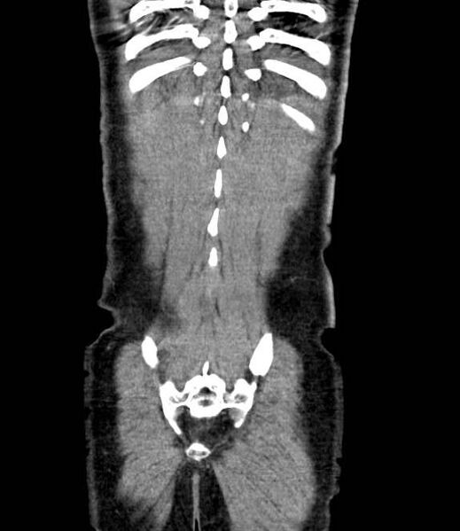 File:Bowel obstruction from colon carcinoma (Radiopaedia 22995-23028 C 69).jpg
