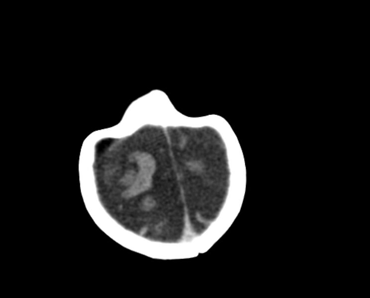 File:Brachycephaly (bi-coronal and bi-lambdoid synostosis) (Radiopaedia 55048-61413 Axial non-contrast 50).jpg