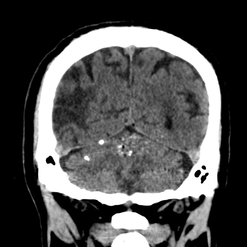 Brain Pantopaque remnants (Radiopaedia 78403-91048 Coronal non-contrast 54).jpg