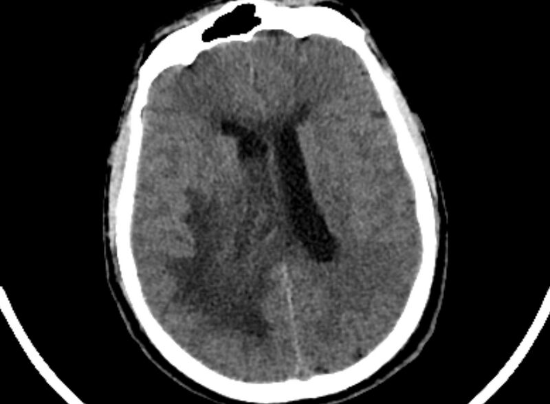 File:Brain abscess complicated by intraventricular rupture and ventriculitis (Radiopaedia 82434-96575 Axial non-contrast 60).jpg