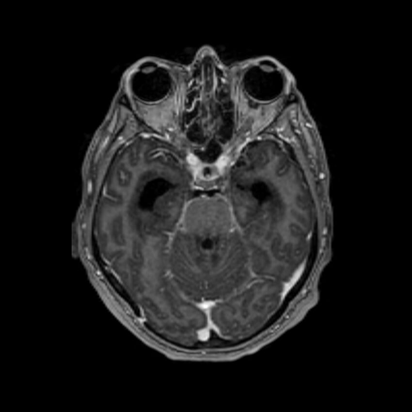 Brain abscess complicated by intraventricular rupture and ventriculitis (Radiopaedia 82434-96577 Axial T1 C+ 21).jpg