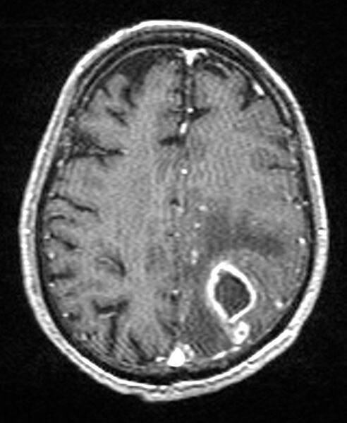File:Brain abscess with dual rim sign (Radiopaedia 87566-103938 Axial T1 C+ 116).jpg