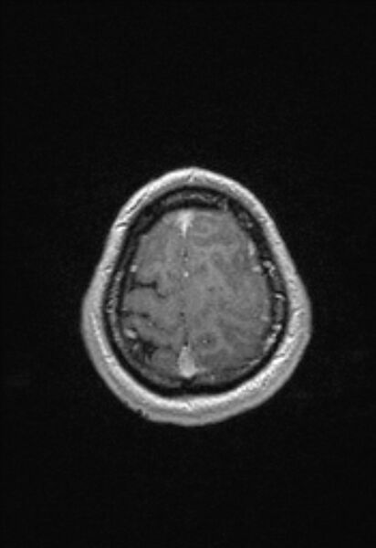 File:Brain abscess with ventriculitis (Radiopaedia 85703-101495 Axial T1 C+ 150).jpg