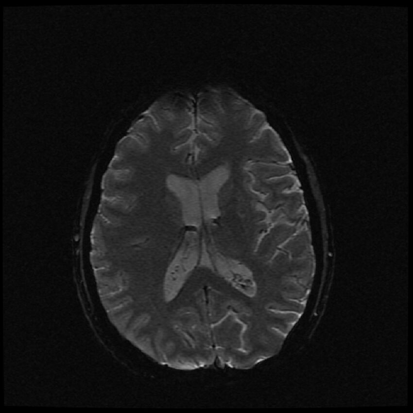 Brain metastases (renal cell carcinoma) (Radiopaedia 42571-45704 Axial SWI 25).jpg