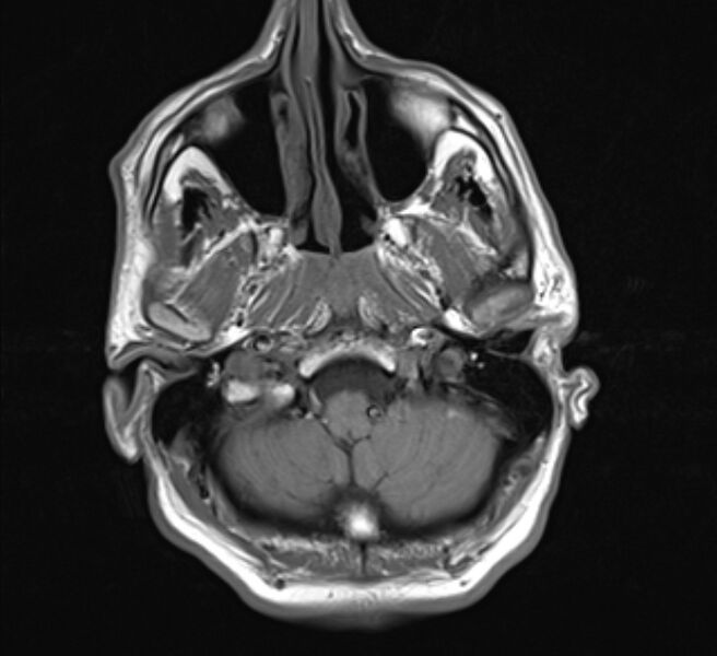 File:Brain metastases - lung cancer primary (Radiopaedia 75060-86115 Axial T1 5).jpg