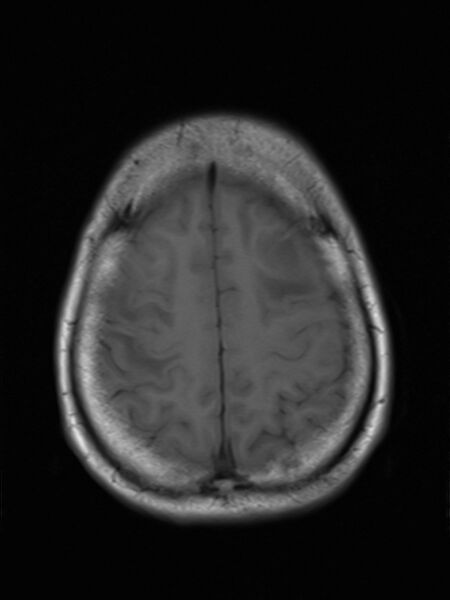 File:Brain metastasis as initial presentation of non-small cell lung cancer (Radiopaedia 65122-74126 Axial T1 16).jpg