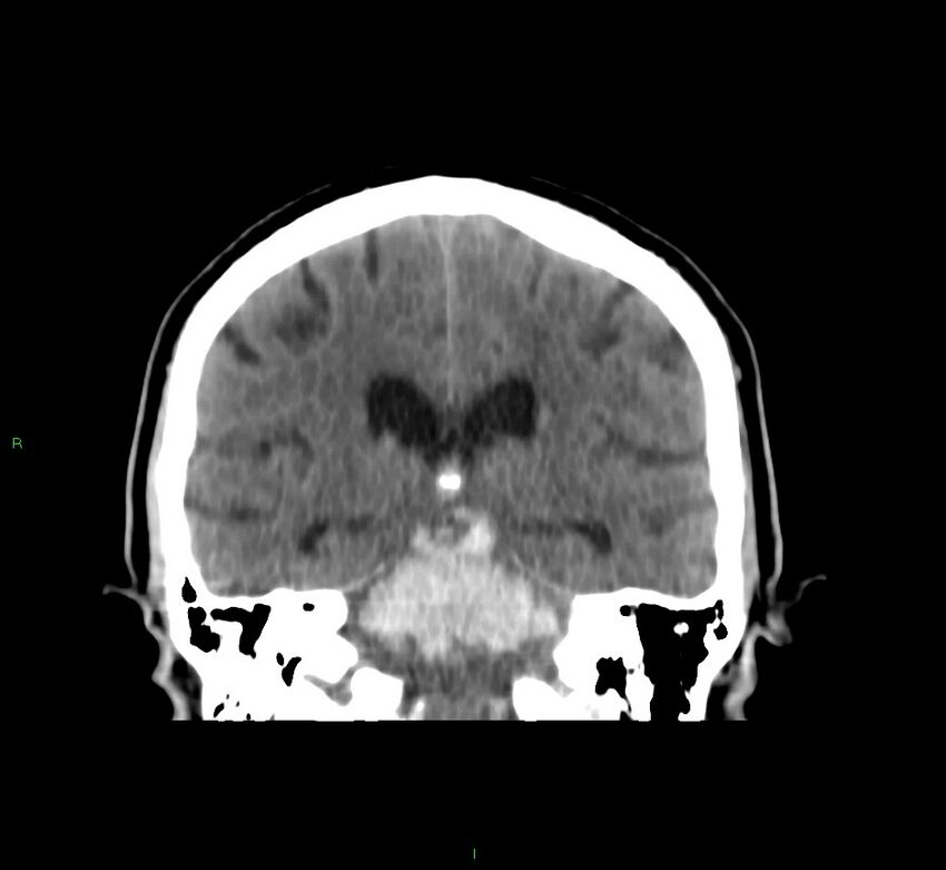 Brainstem hemorrhage (Radiopaedia 58794-66028 Coronal non-contrast 29).jpg